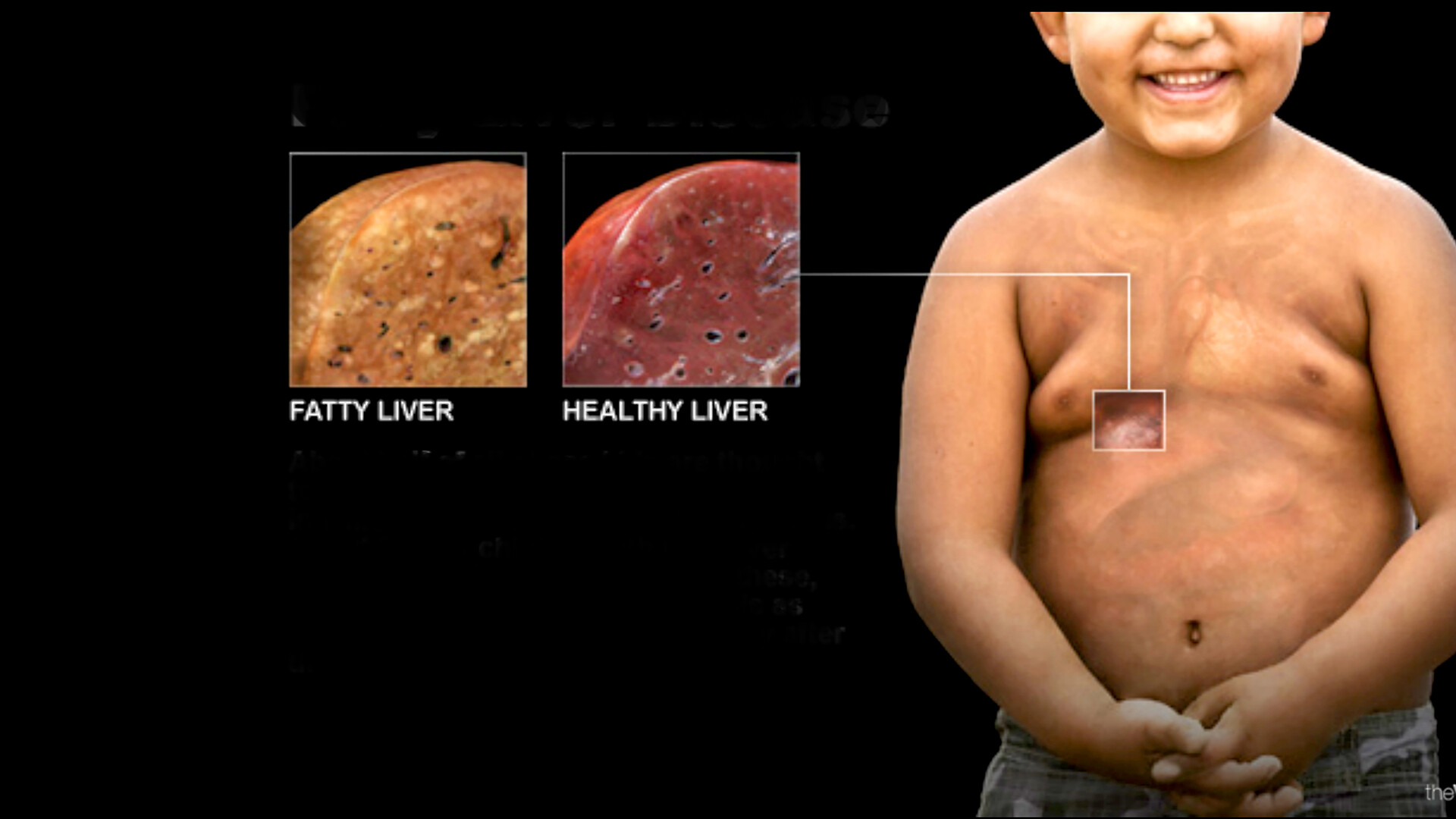 Fatty-liver