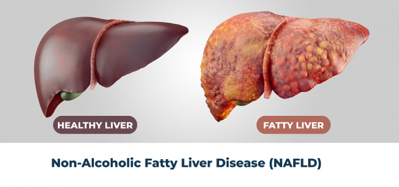 Fatty-liver